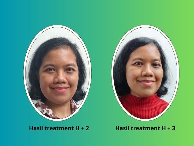Hasil treatment